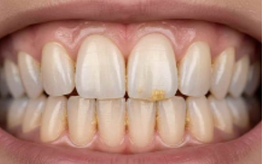 Smilepro : Elimina placa y manchas en casa, sin ir a el dentista - Incluye kit completo de Limpieza.